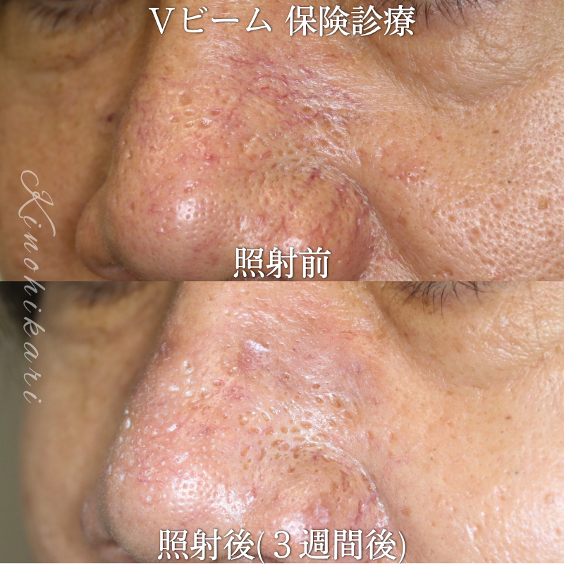【Vビーム 保険診療】鼻背部の毛細血管拡張症を治したい方【症例No.29YG00001065】