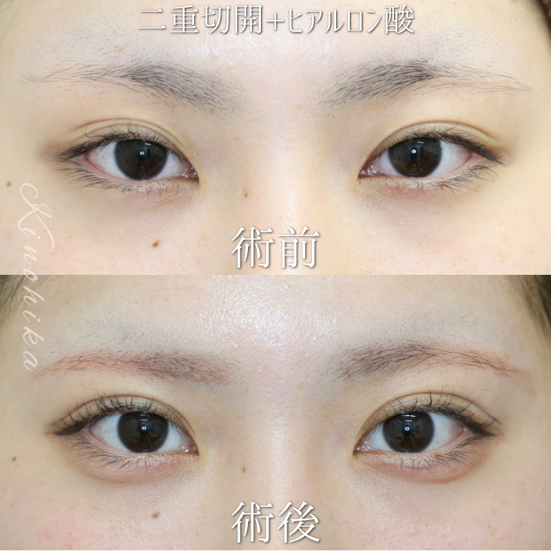 【二重埋没法＋涙袋ヒアルロン酸】二重幅を整えてやわらかな目元にしたい方【症例No.29YN00001045】