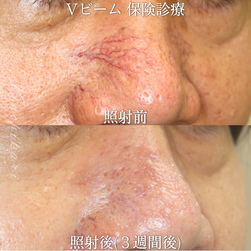 【Vビーム 保険診療】鼻背部の毛細血管拡張症を治したい方【症例No.29YG00001065】