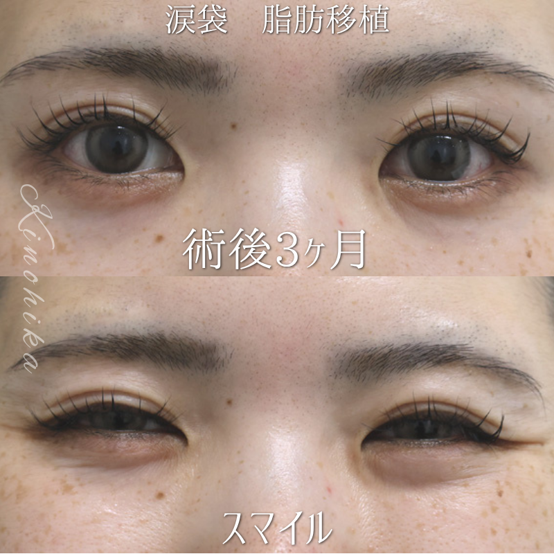【脂肪移植による涙袋形成】永久的な涙袋が欲しい20代の方【症例No.29Y00001037】