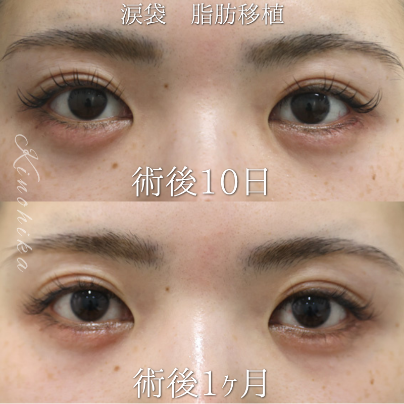 【脂肪移植による涙袋形成】永久的な涙袋が欲しい20代の方【症例No.29Y00001037】