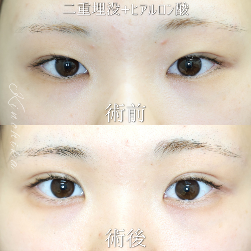 【二重埋没法+涙袋ヒアルロン酸】二重幅を整えてぱっちり見せたい方【症例No.29YN00001039】