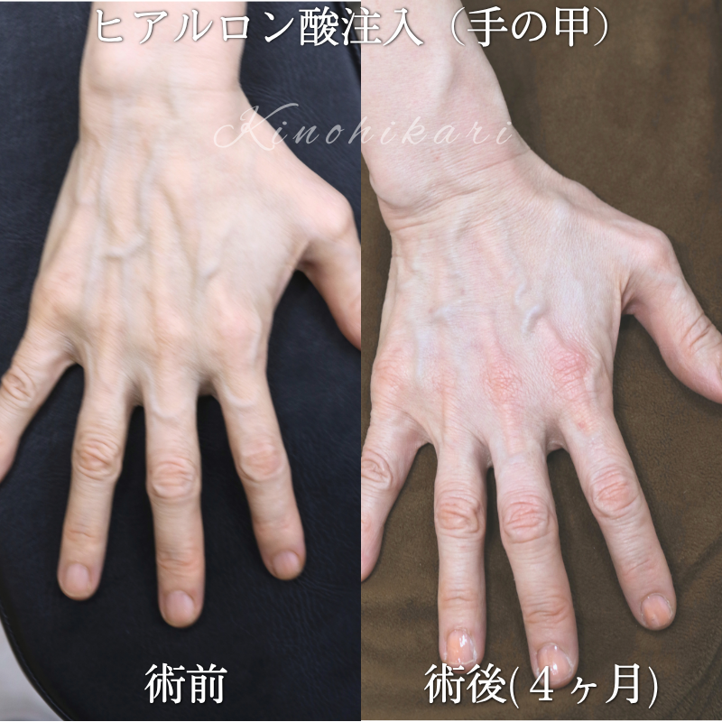 【手の甲ヒアルロン酸注入：ハンドリジュビネーション（手の若返り治療）】年と共に手のエイジングを感じる50代の方【症例No.29Y00001068】