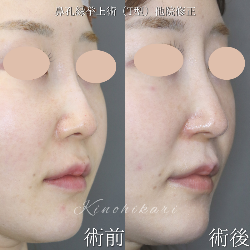 【鼻孔縁挙上術(T型)他院修正】鼻翼縮小術の修正、鼻翼の形態を少しだけ変化させたい 30代女性【症例No.29Y00001023】