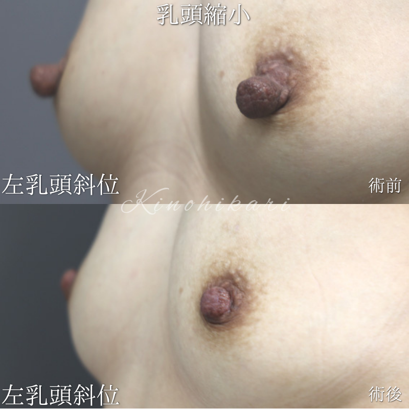 【乳頭縮小】乳頭のたるみに悩む 40代女性【症例No.29Y00001034】