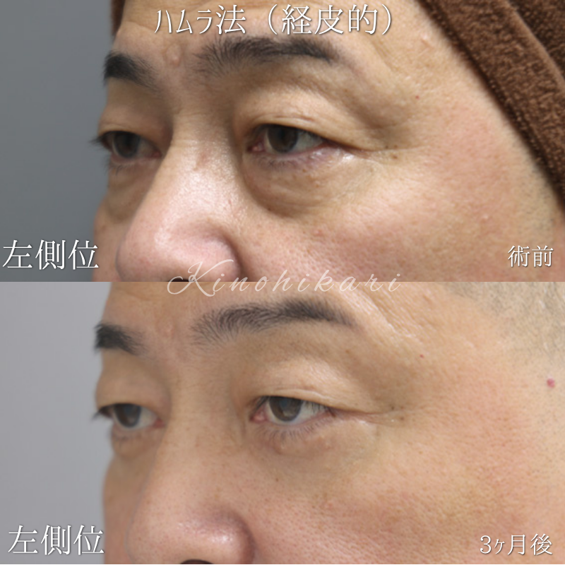 【経皮的ハムラ】目の下のクマが原因で年齢以上に見える 50 代の方【症例 No.29Y00001035】