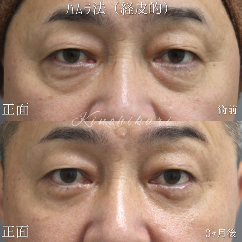【経皮的ハムラ】目の下のクマが原因で年齢以上に見える 50 代の方【症例 No.29Y00001035】