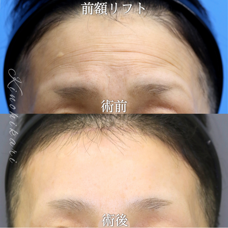 【前額リフト】おでこに刻まれたしわが気になる　60代の方【症例No.29Y00001080】