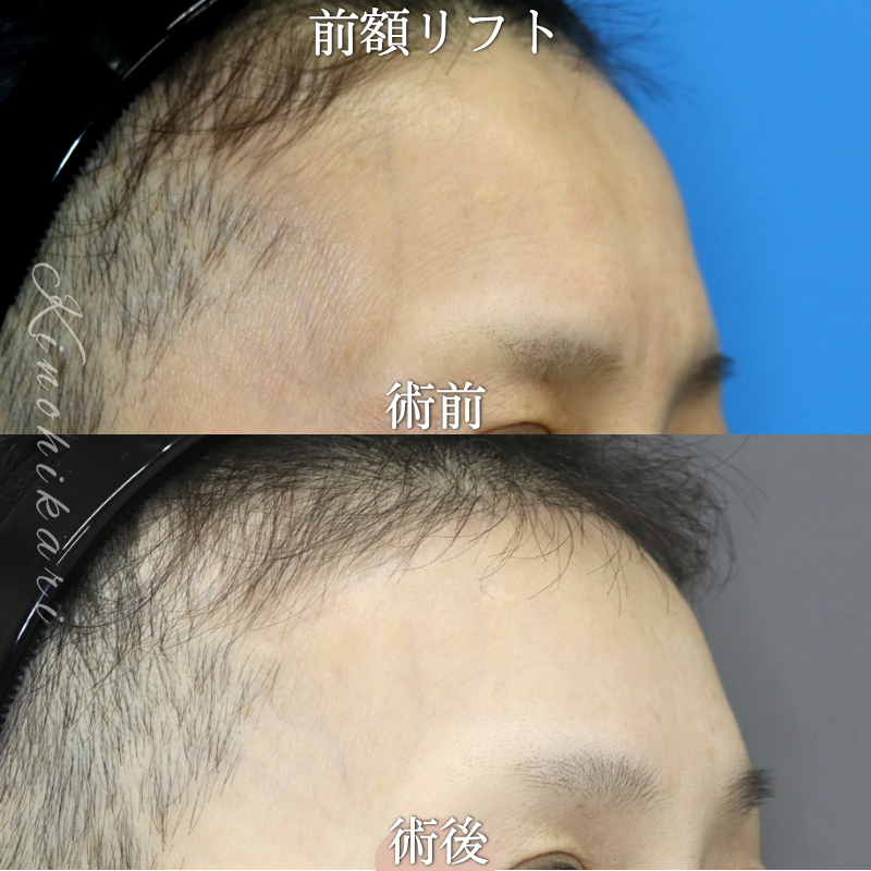 【前額リフト】おでこに刻まれたしわが気になる　60代の方【症例No.29Y00001080】