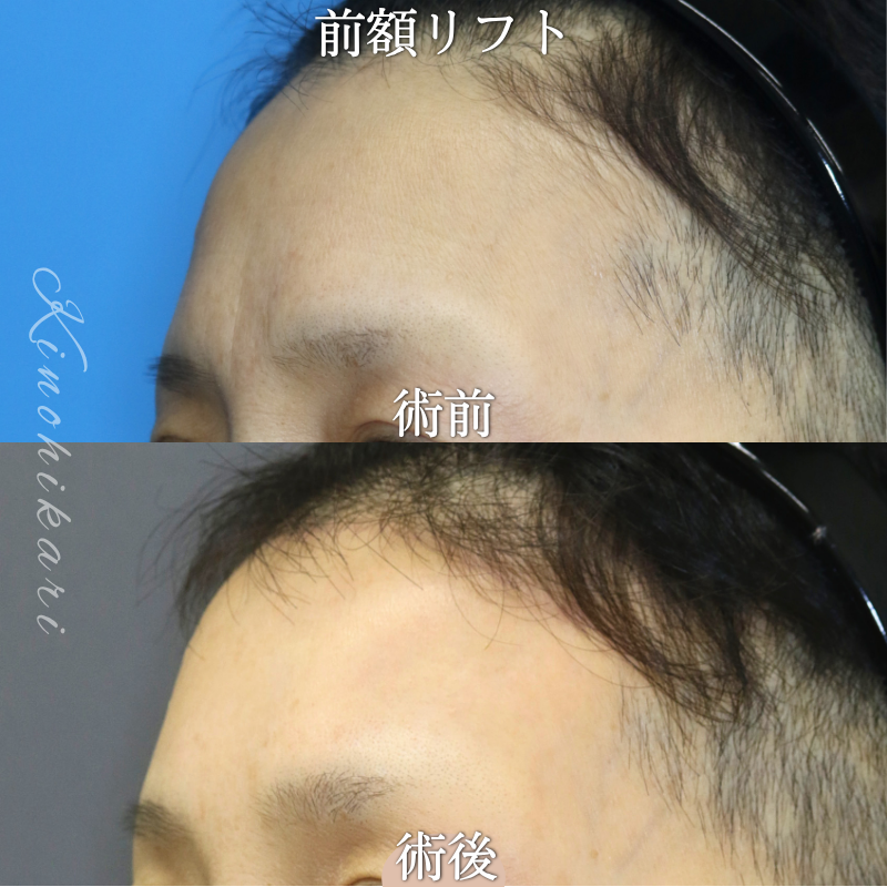 【前額リフト】おでこに刻まれたしわが気になる　60代の方【症例No.29Y00001080】