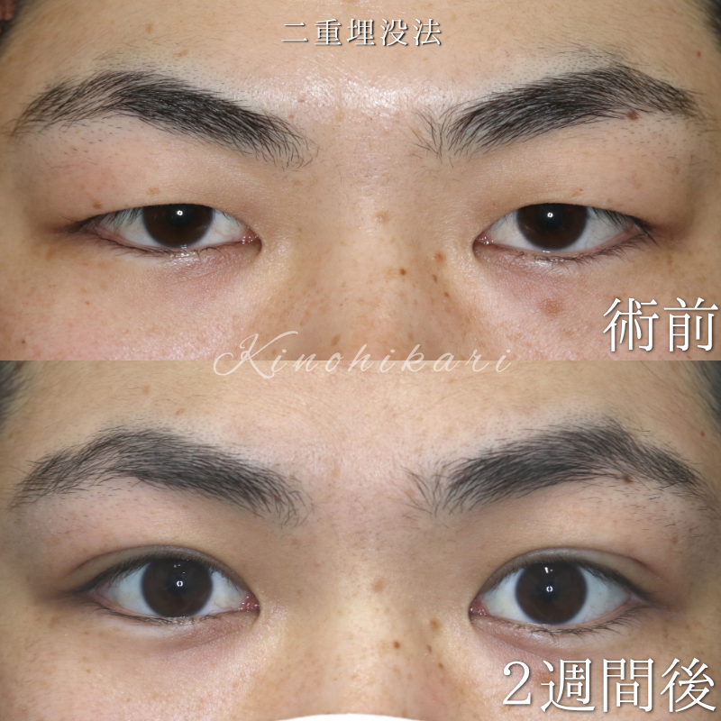 【二重埋没法】 一重から、ぱっちりとした自然な二重にしたい方 【症例No.29Y00001092】