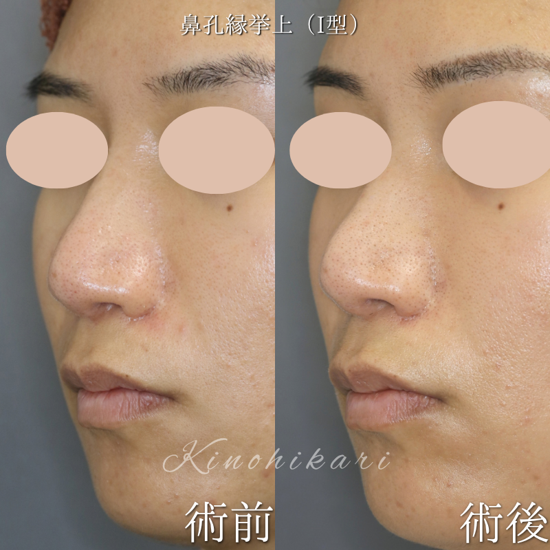 【鼻孔縁挙上術(I型)・他院修正】 鼻孔縁の左右差を改善したい30代の方 【症例No.29Y00001091】
