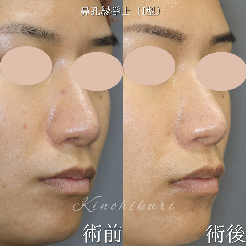 【鼻孔縁挙上術(I型)・他院修正】 鼻孔縁の左右差を改善したい30代の方 【症例No.29Y00001091】