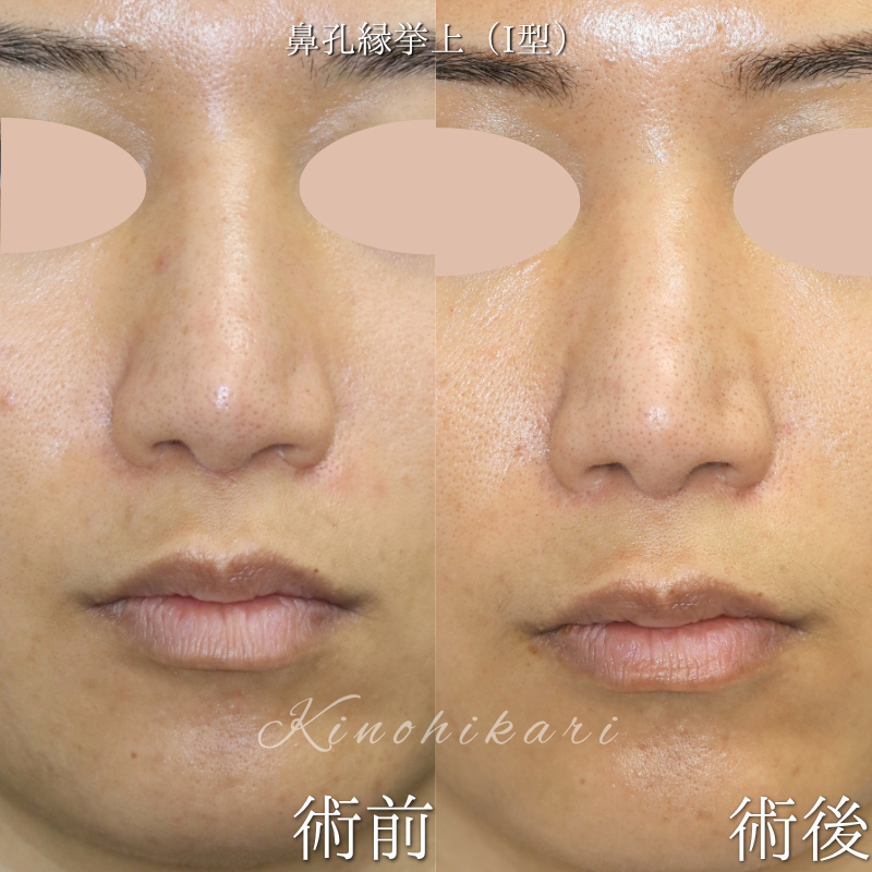 【鼻孔縁挙上術(I型)・他院修正】 鼻孔縁の左右差を改善したい30代の方 【症例No.29Y00001091】