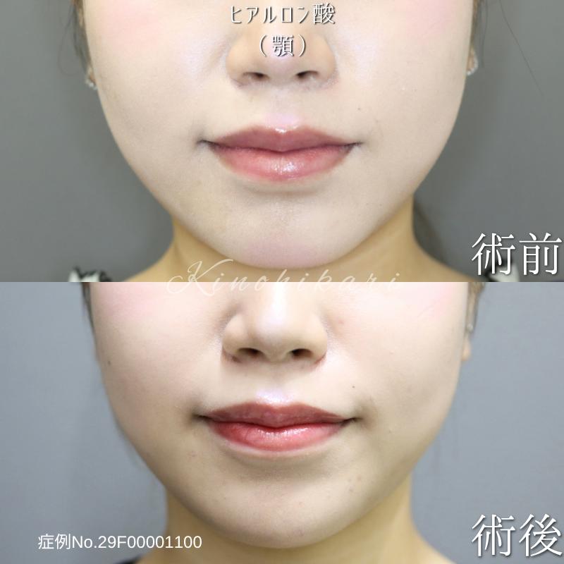【顎ヒアルロン酸注入】 自然な立体感をプラスし、すっきりとした横顔へ【症例No.29F00001100】
