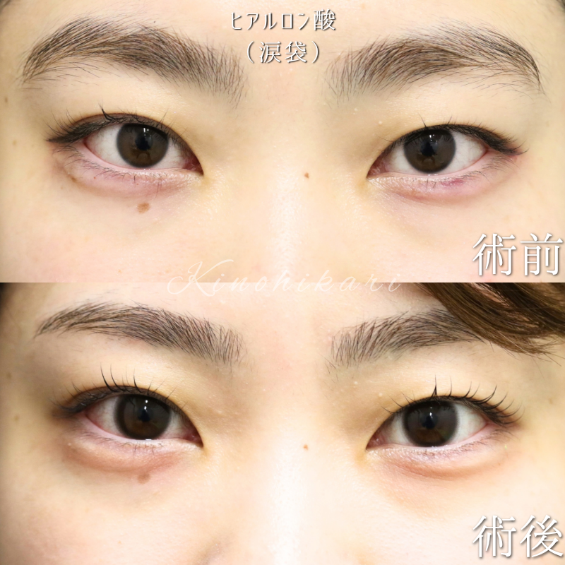 【涙袋ヒアルロン酸注入】 自然なボリュームで、優しく華やかな目元へ 【症例No.29FYG00001098】